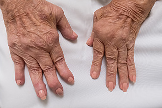 Artritida kloubů na rukou – postižené klouby je potřeba šetřit