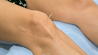 Akupunkura může být použita v rámci léčby artrózy kolene.