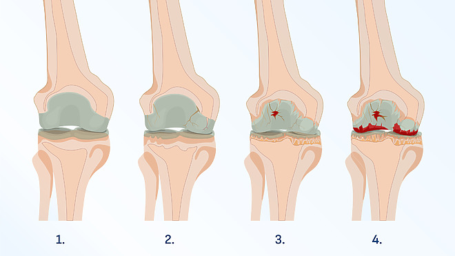 Stádia artrózy kolene