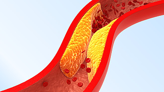 Ateroskleróza – tukové částice se hromadí v cévách