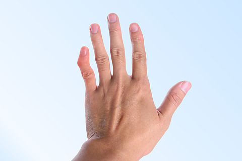 Deformace prstu - jeden z příznaků zlomeniny