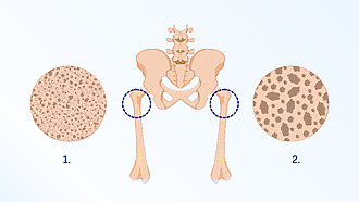 Denzitometrie ukáže hustotu kostní tkáně