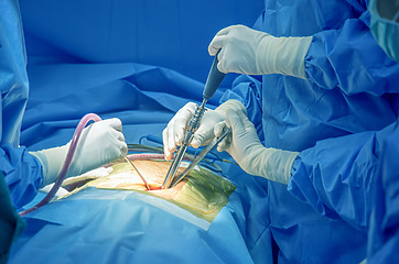 V nejzávažnějších případech se řeší ischias operací zad