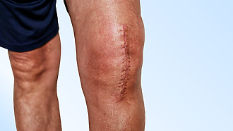 Podoba jizvy po endoprotéze kolene