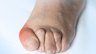 Kladívkové prsty zvyšují riziko syndromu diabetické nohy