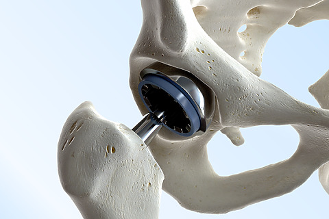Náhrada kyčelního kloubu umělým implantátem