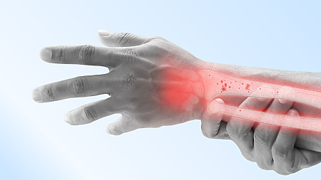 Osteoporóza – častá příčina zlomenin