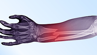 Definice zlomeniny: narušení celistvosti kosti