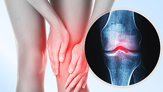 Artróza v kolenním kloubu