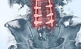 Rentgenový snímek bederní páteře po operaci – zpevnění postiženého místa železnými šrouby
