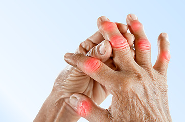 Klouby na prstech ruky mohou být zvětšené a zdeformované
