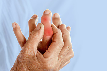 Klouby na prstech ruky mohou být zvětšené a zdeformované