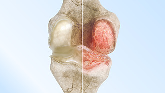 Zdravá a poškozená kloubní chrupavka – kolenní kloub